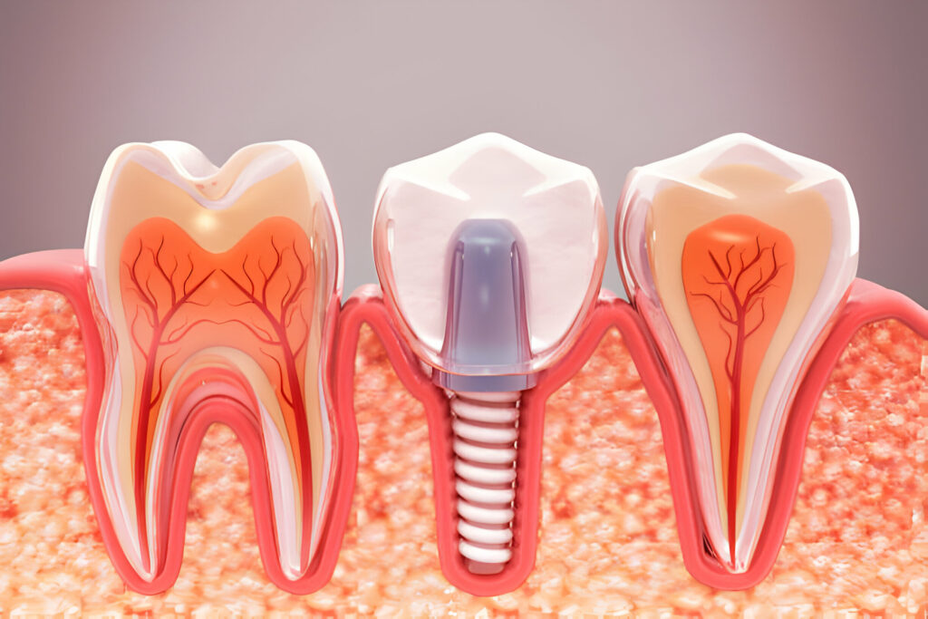 A Comprehensive Guide to Dental Implant Types: Which Option is Right for You?_1