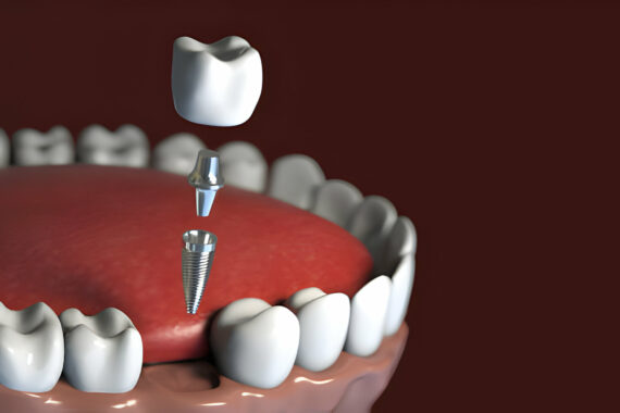 A Comprehensive Guide to Dental Implant Types: Which Option is Right for You?_FI