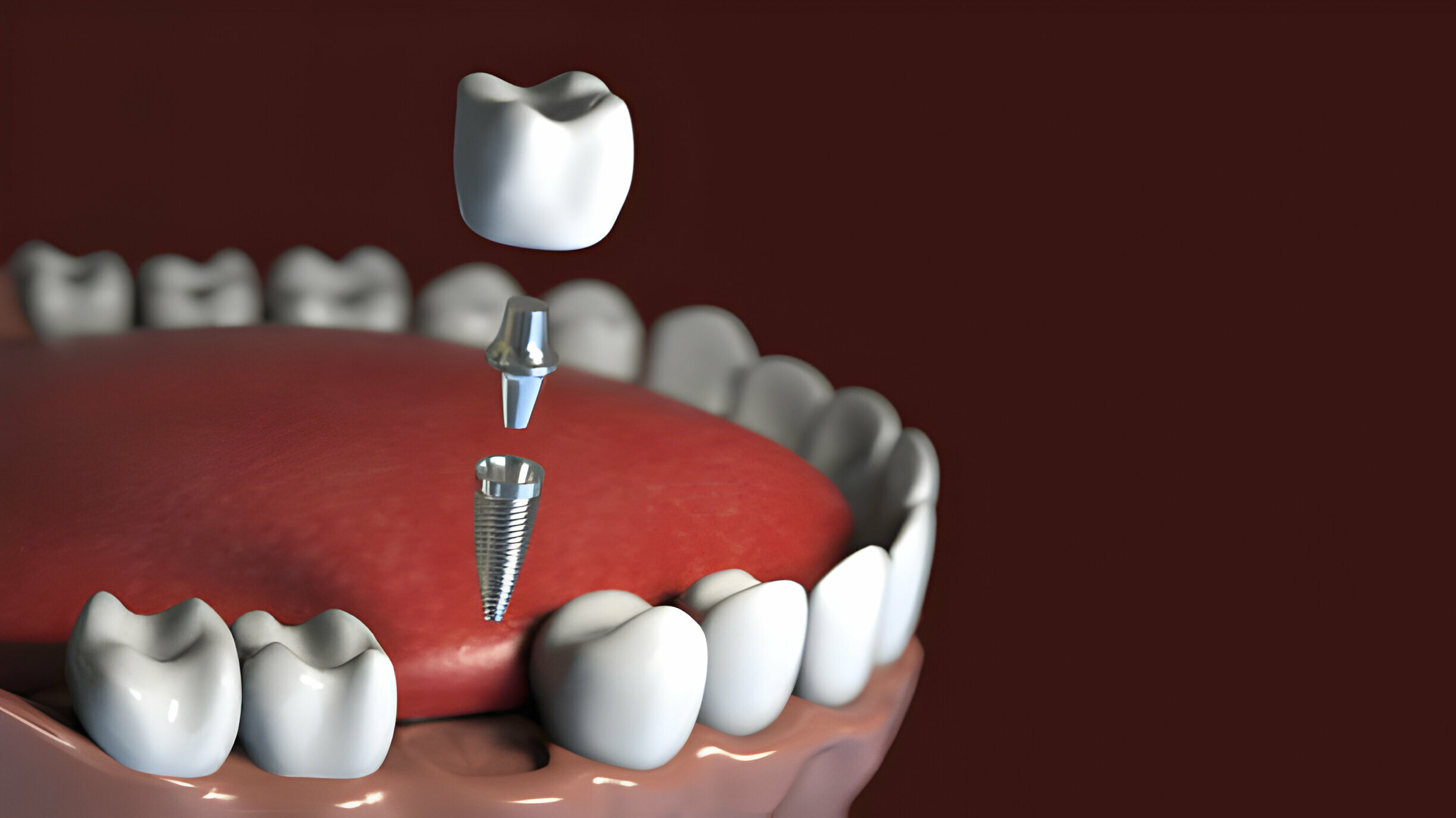 A Comprehensive Guide to Dental Implant Types: Which Option is Right for You?_FI
