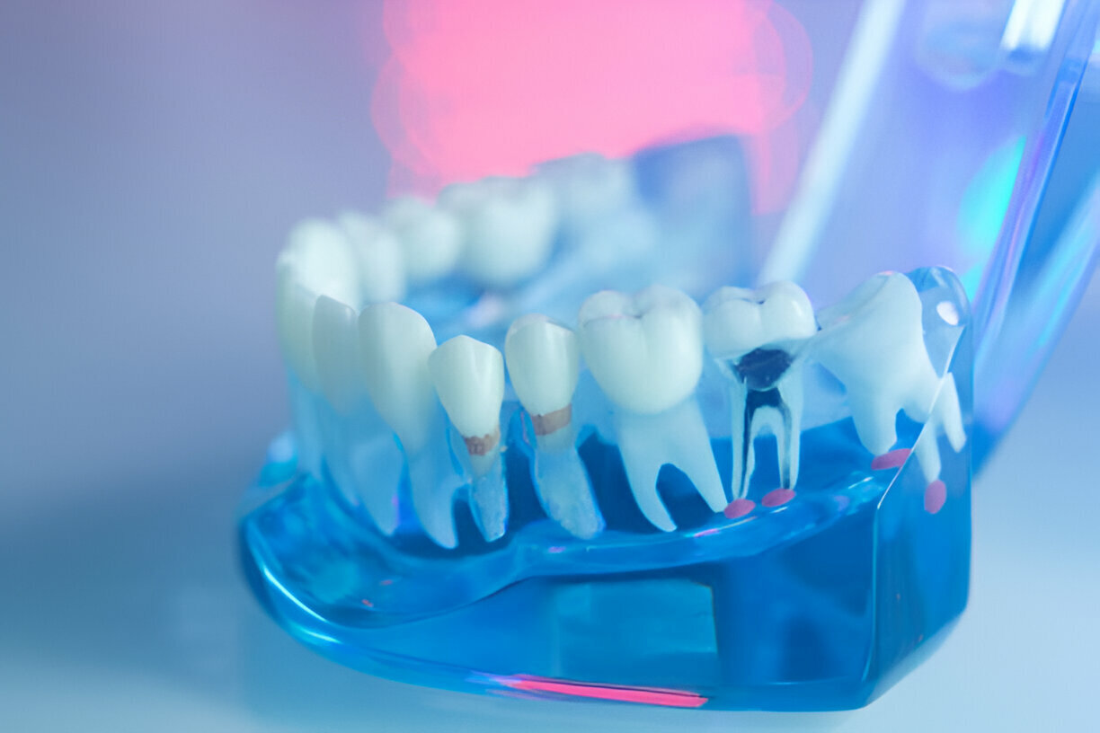 Expert Tips for Choosing the Right Dentist for Your Root Canal_FI