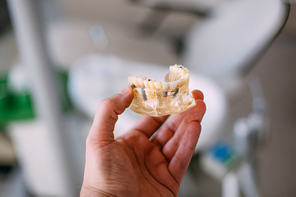 A Comprehensive Guide to Dental Implant Options from Rowan Family Dentistry, Your Mississippi Dentist_3