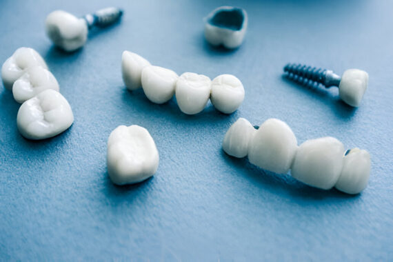 A Comprehensive Guide to Dental Implant Options from Rowan Family Dentistry, Your Mississippi Dentist_FI