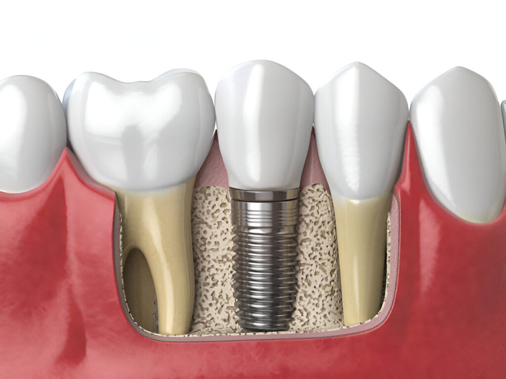 Exploring Dental Implant Options at Rowan Family Dentistry: Trusted Dentist in Mississippi_3