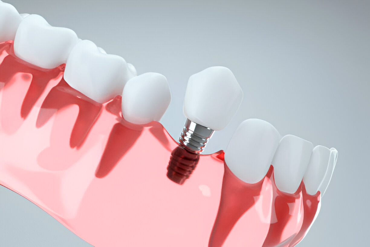 Exploring Dental Implant Options at Rowan Family Dentistry: Trusted Dentist in Mississippi_FI